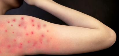 ein Arm mit Affenpocken