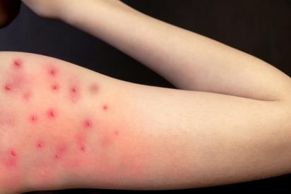 ein Arm mit Affenpocken